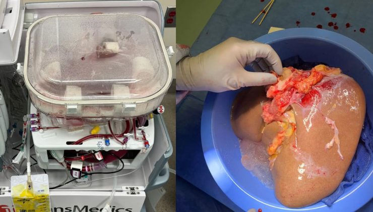 Organ naklinde yeni bir dönem… Cerrahlara zaman kazandırıyor